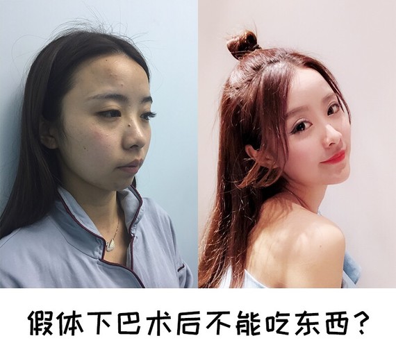 术后一周收购吃氨基糖奈类的活血化瘀的药物,v药物价格避免伤口蛋愈合鹌鹑图片