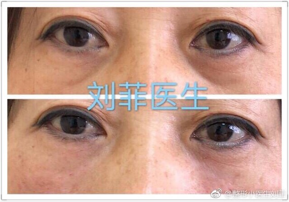 刘菲医生:眼袋术后导致的下眼睑凹陷,眼袋一旦