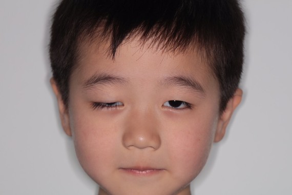 先天性上睑下垂