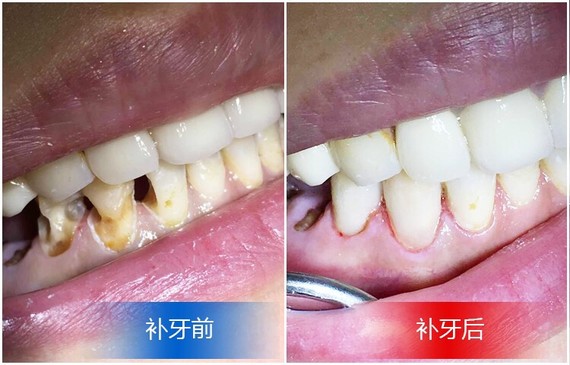 【用树脂材料填充的补牙可以保持多久?】补牙