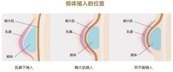 隆胸修复有些女性在一些不正规的美容机构进行假体隆胸术,注射隆胸术