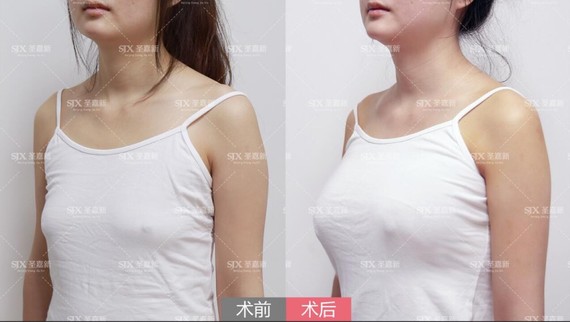 多大罩杯才最合适?一次能达到理想效果吗?