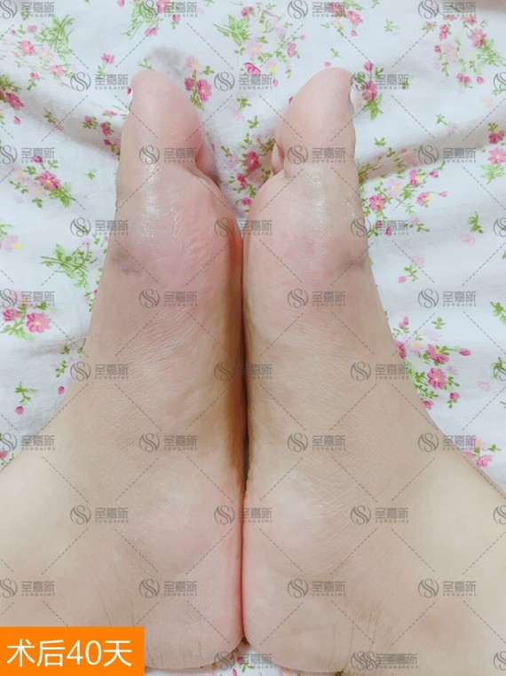 马大大美足百科#大脚骨案例分享术前情况:中度大脚_圈子-新氧美容