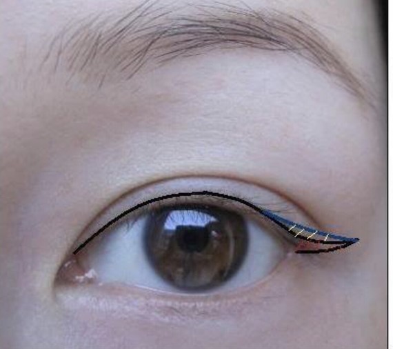 割双眼皮手术有什么危险吗?怎么避免出现这些