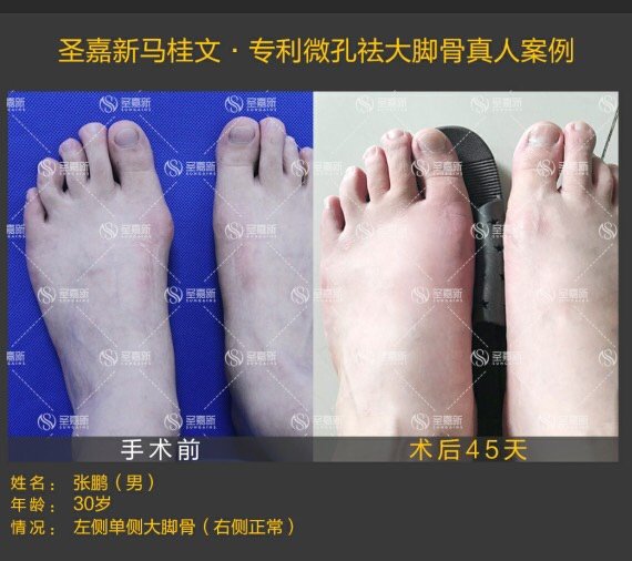 马大大美足百科#大脚骨案例分享