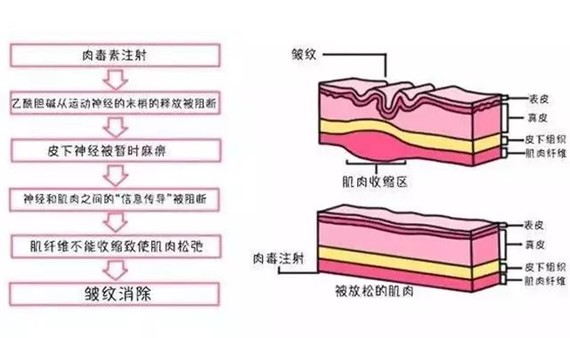 肉毒素是一种纯化蛋白质,作用于肌肉组织.