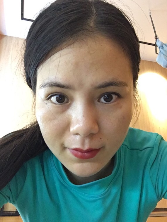 鼻子太难看,原来做了玻尿酸填充鼻头现在似乎变大了,希望可以拯救