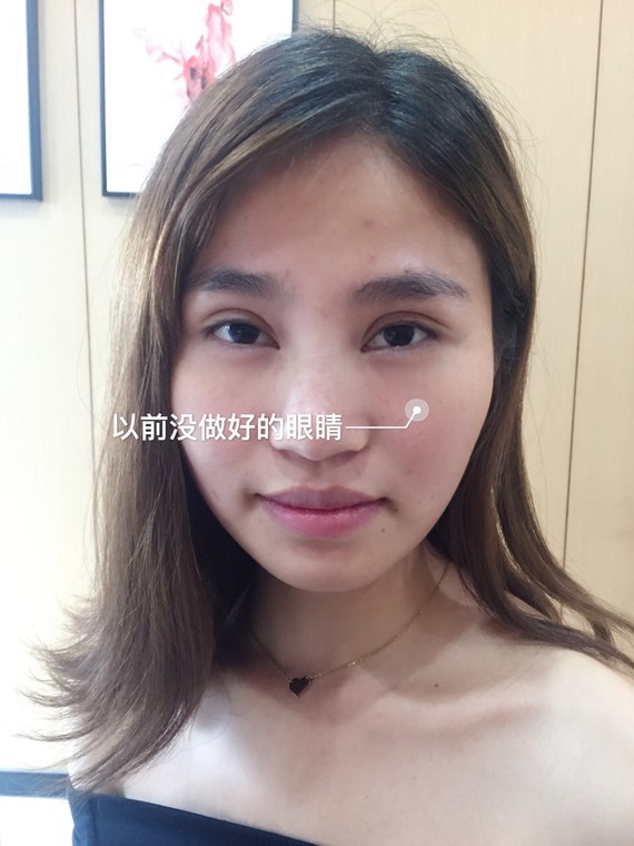双眼皮修复手术做了一年多了,找了几张照片,想