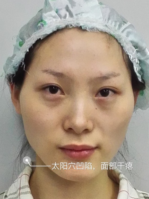 拯救面部凹陷干瘪大作战!
