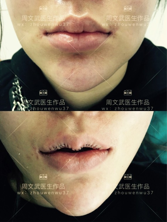 唇修复一例,唇部手术不满意修复时间建议半年,等疤痕和形态稳定了再