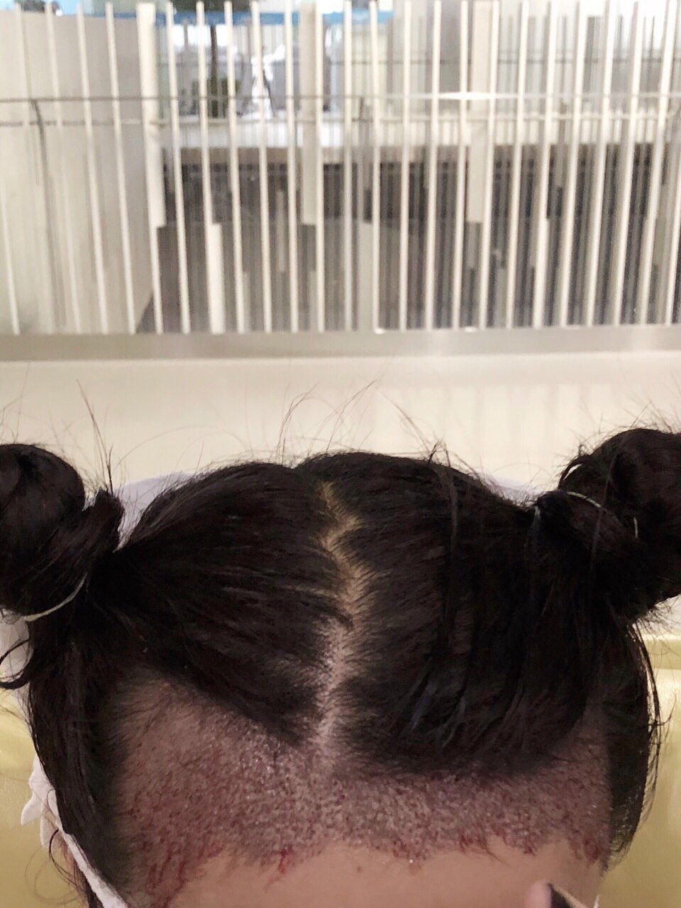 大脑门少女的植发分享,欢迎围观