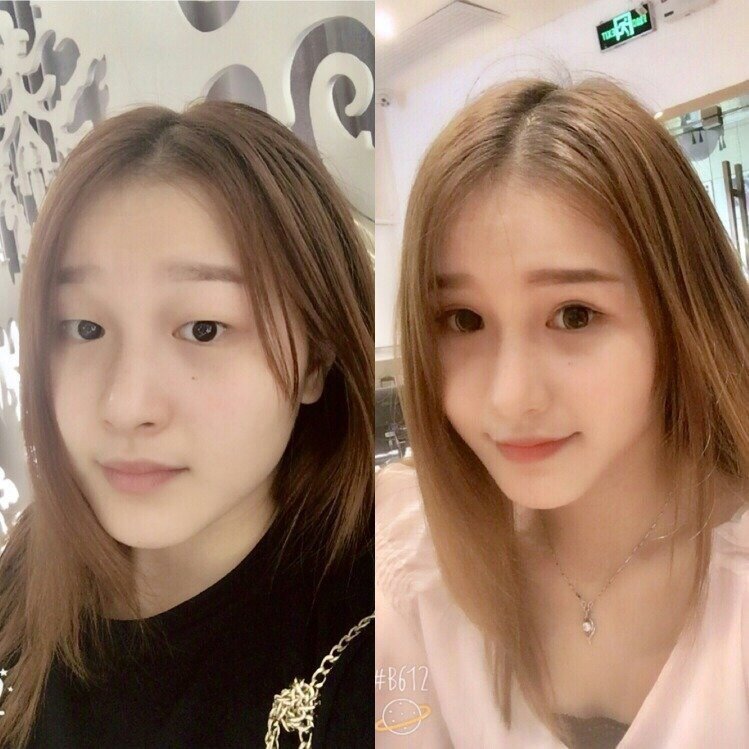 全切双眼皮 上睑提肌手术术后记录,后悔没开眼角