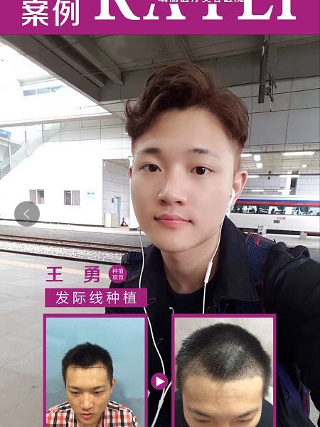 植发手术成活率高--植发手术种植后的毛囊成活