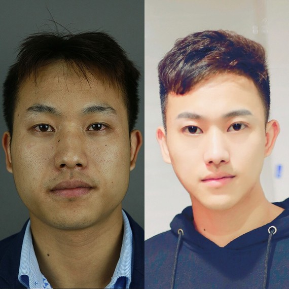 当你还在考虑要不要来支玻尿酸,tony许已经开始削骨了