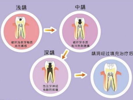 你知道你是哪种牙痛吗?风风火火的红肿型牙