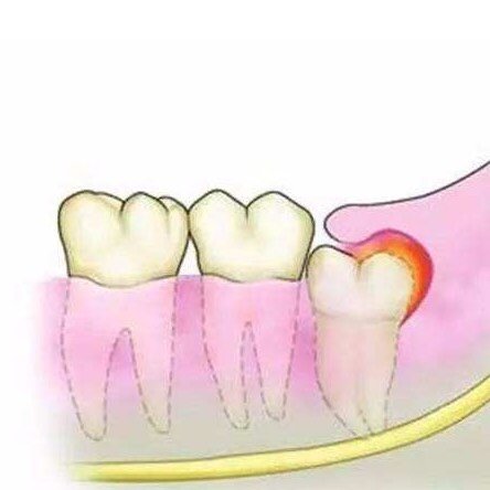 你知道你是哪种牙痛吗?风风火火的红肿型牙