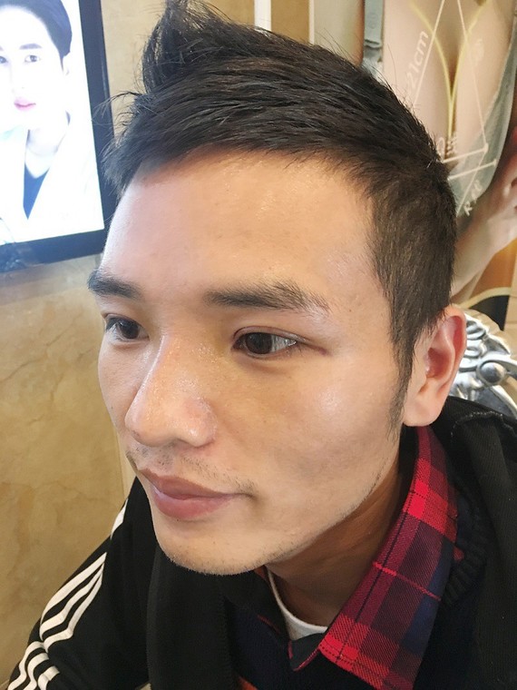 隆鼻术后护理技巧分享,恢复时间、疤痕增生等