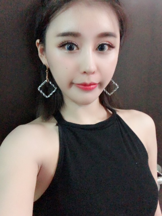 图3就是奥美定取出来的图片取出后一年下巴填充了玻尿酸  奥美定的
