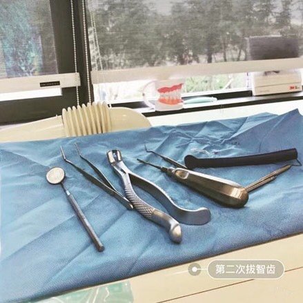 带着专业牙医分享我的拔智齿经验,早拔早轻松