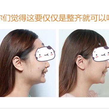 l:我是深覆合,但是我的牙齿挺整齐,笑起来也正常,我觉得我不