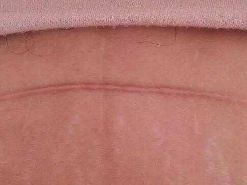 剖腹产新伤口如何护理?想要避免出现难看的剖