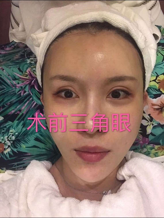 新氧- 下至日 | 眼部 | 双眼皮 | 切开双眼皮 | 眼部修复 | 梧州同城