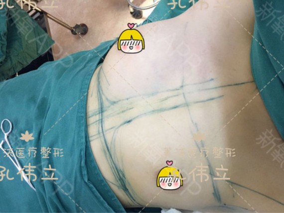 自体脂肪隆胸后术后怎么正确按摩呢?