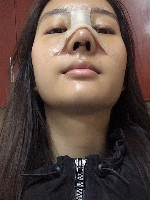 什么是鼻综合整形术综合隆鼻整形是通过植入适