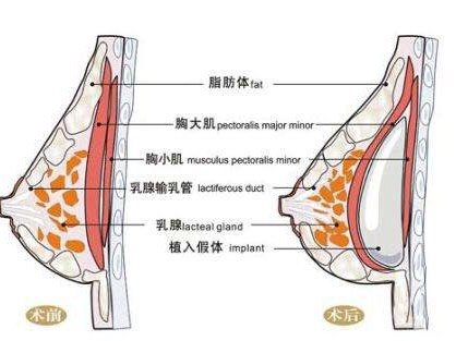 假体隆胸术是什么 关于假体隆胸术的详细介绍