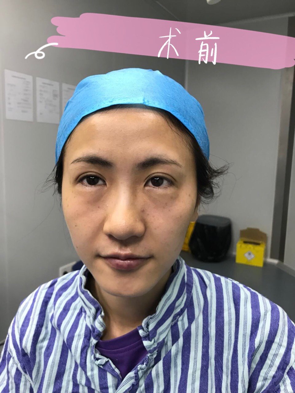 广州探店# 去眼袋之后眼窝会凹陷?我来亲测一下!