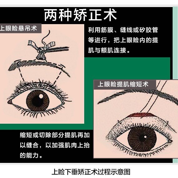 上睑下垂的矫正有两种方法,一是直接缩短上睑提肌,是