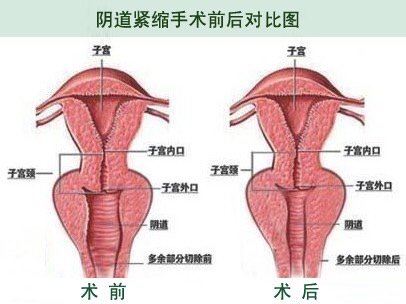 私处整形如何做到看不出?