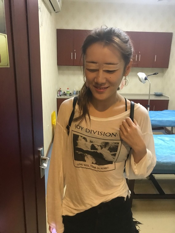 割双眼皮后出现血肿正常吗割双眼皮会出现轻度