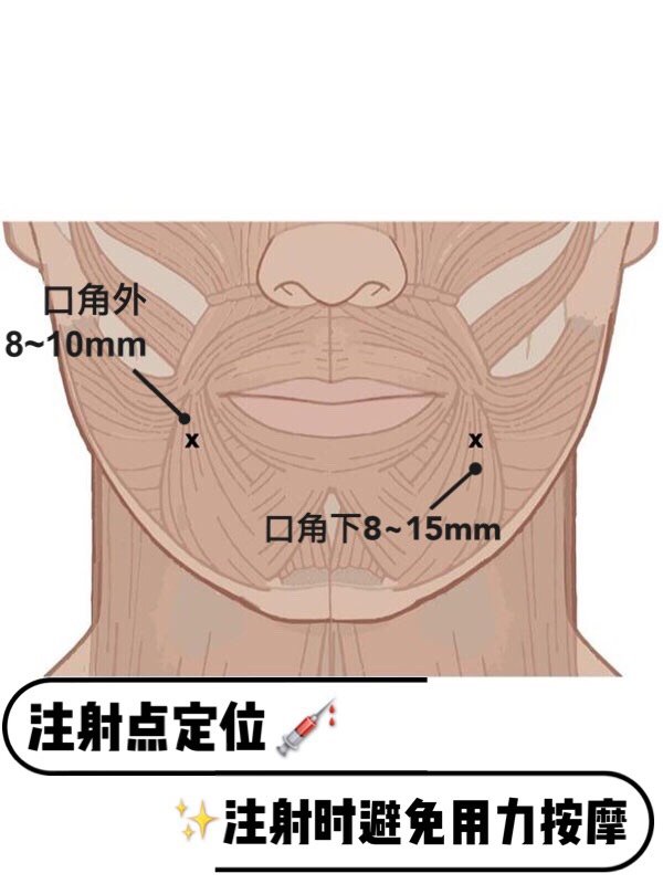 93采用肉毒素治疗先天性口角下垂,治疗前要对求美者_圈子-新氧美容