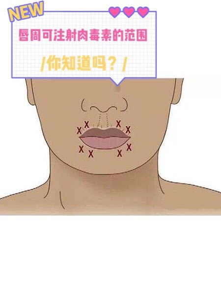 93采用肉毒素治疗先天性口角下垂,治疗前要对求美者_圈子-新氧美容