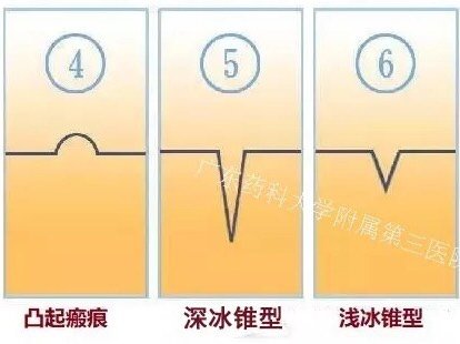 脸上痘坑是怎么形成的?许多人痘痘消失后脸上