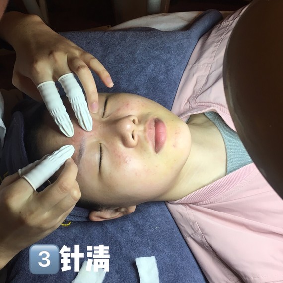 痘痘粉刺千万别乱抹只有医美针清才能根治