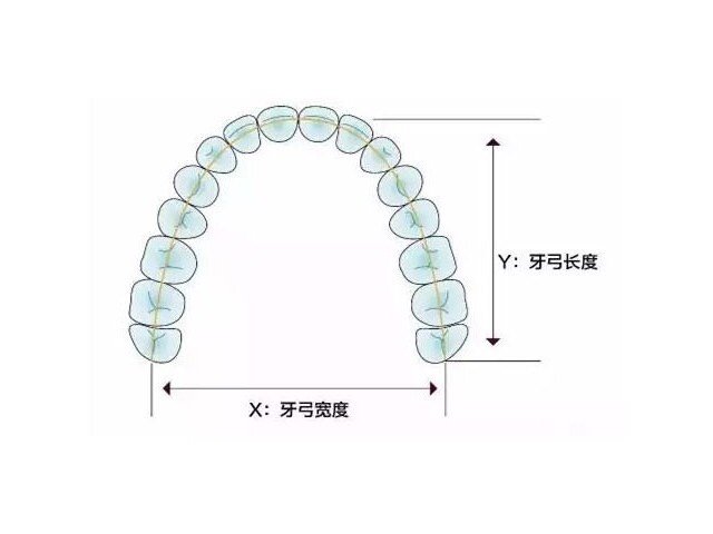 【独家揭秘】牙齿矫正扩弓会使脸型变大吗?