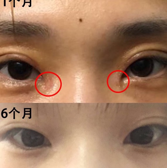 刚开完眼角疤痕增生严重,恢复6个月后是什么样子?