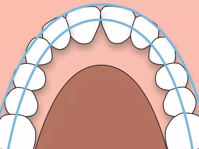 【独家揭秘】牙齿矫正扩弓会使脸型变大吗?