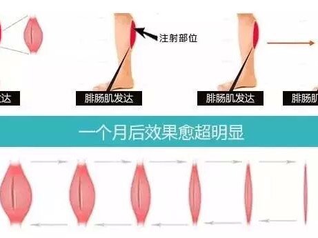 打了医生针大腿越来越粗了!Why?车后腿告诉大瘦腿松了瘦腿肉变怎么图片