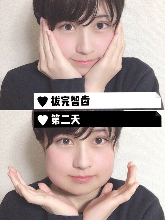 日本肥肠拔完智齿第2天微博上看到的图,笑死我做法妹子辣椒拿糕吃图片