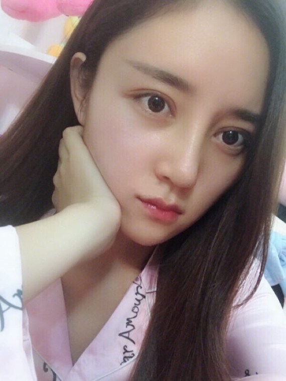 隆鼻 | 自体脂肪填充全脸 | 九江同城 | 自体脂肪填充 | 真人案例