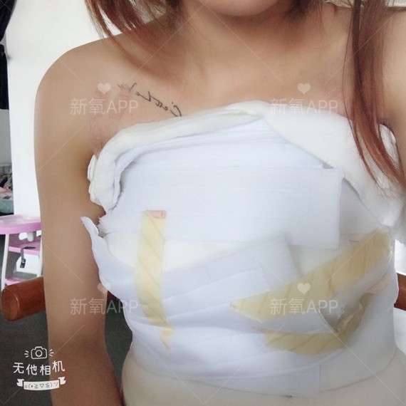 假体隆胸恢复,是一种什么样的体验?