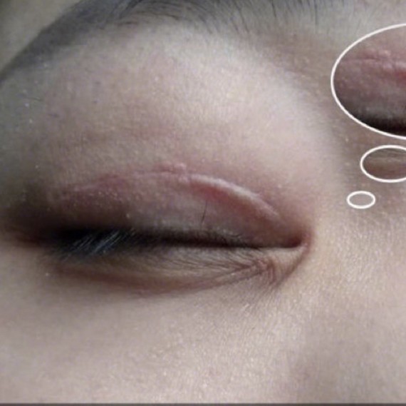 整形科普|割双眼皮手术失败的5大症状