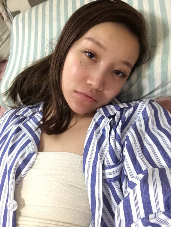 ♀体验者:艾吉尔项目:自体脂肪隆胸机构:北京知