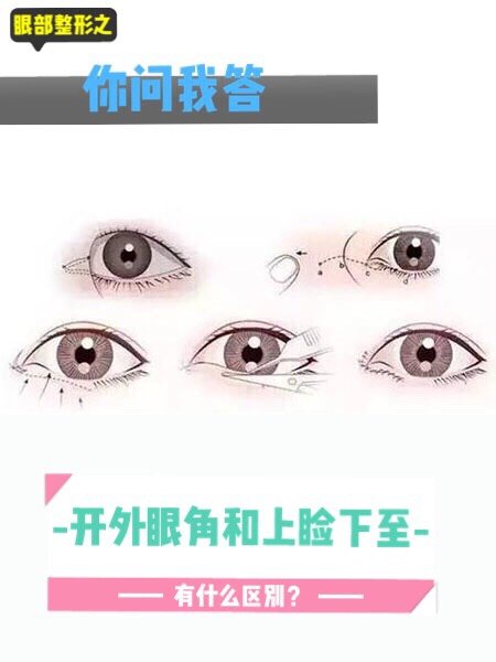 眼部整形之你问我答——开外眼角和眼睑下至的区别?(二)