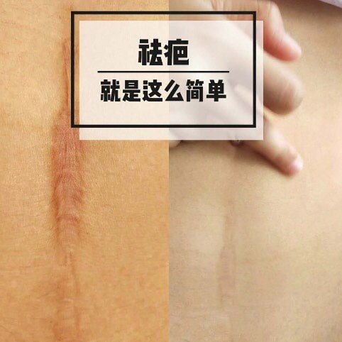 剖腹产疤痕怎么办?产后妈妈看这里