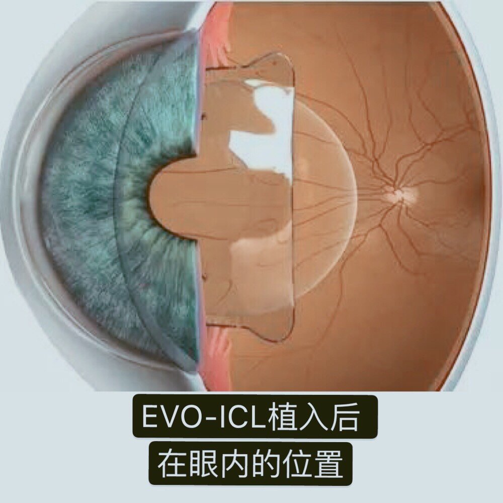 如果重新选择,99.4%的人表示还会选择icl手术!