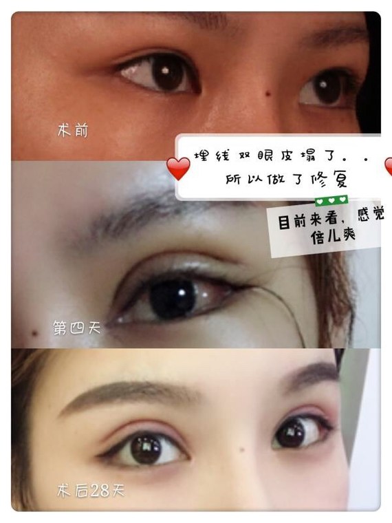 埋线双眼皮